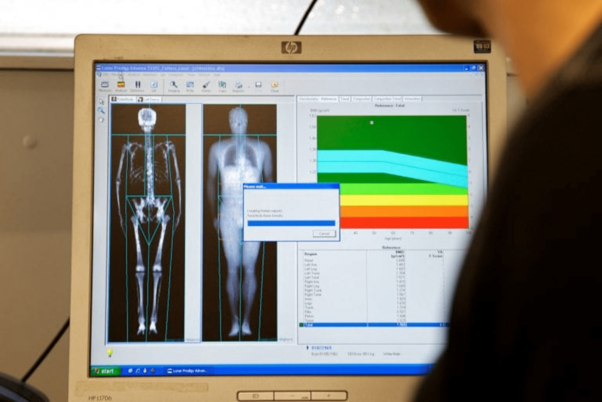 DEXA Scan Radiation – Is It Safe?