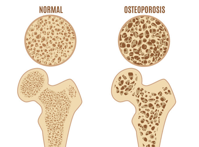 Example of normal bone vs bone with osteoporosis