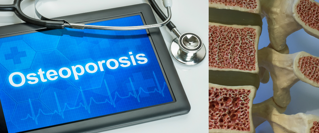 Are You Due for a Bone Density Test? Everything You Need to Know About the Updated Osteoporosis Screening Guidelines